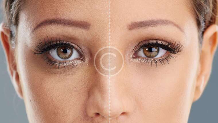 Platelet Rich Plasma therapy effectively treats receding hairlines and promotes hair regrowth.